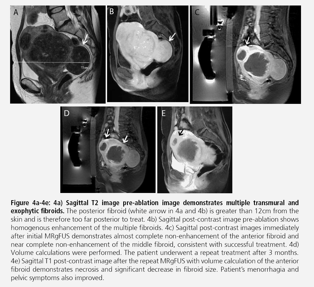 imaging-medicine-Sagittal-t2-images-exophytic-fibroids