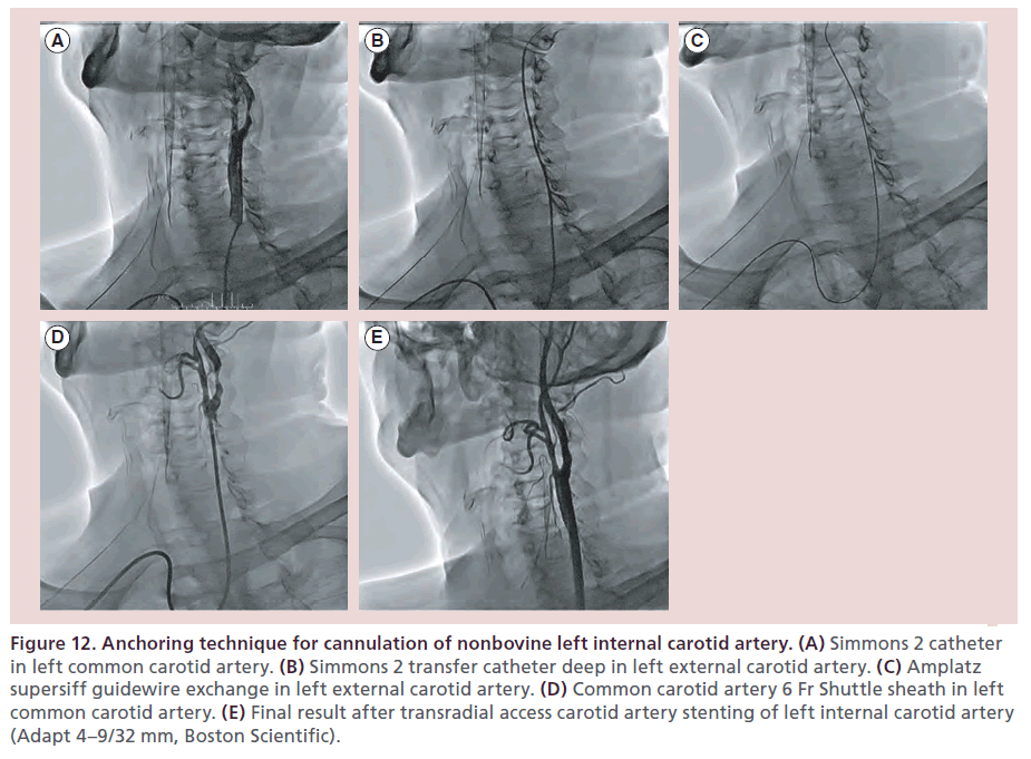 interventional-cardiology-Anchoring-technique