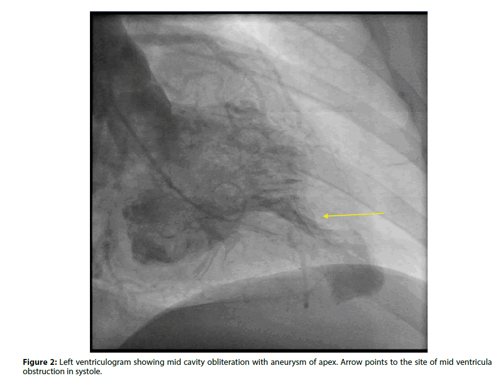 interventional-cardiology-Arrow-points