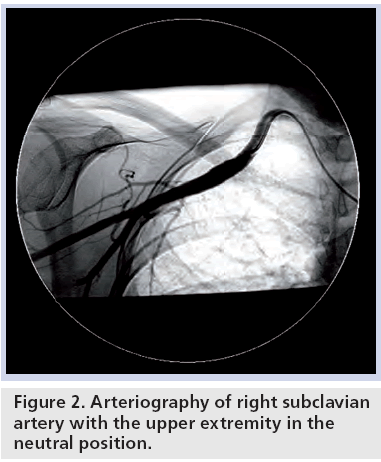 interventional-cardiology-Arteriography-right-subclavian