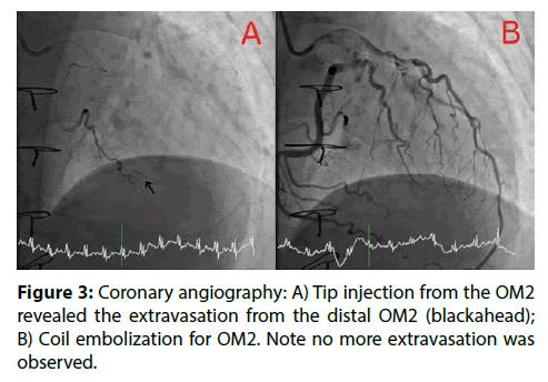 interventional-cardiology-Coil-embolization