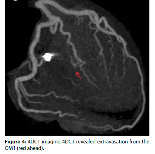 interventional-cardiology-Coil-embolization