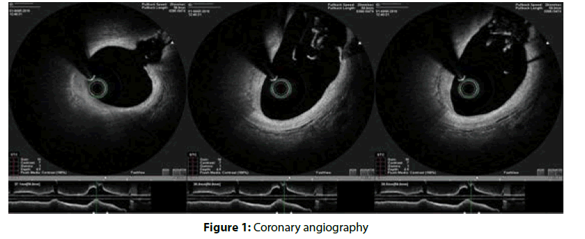 interventional-cardiology-Coronary