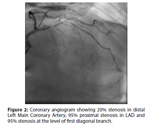 interventional-cardiology-Coronary-angiogram