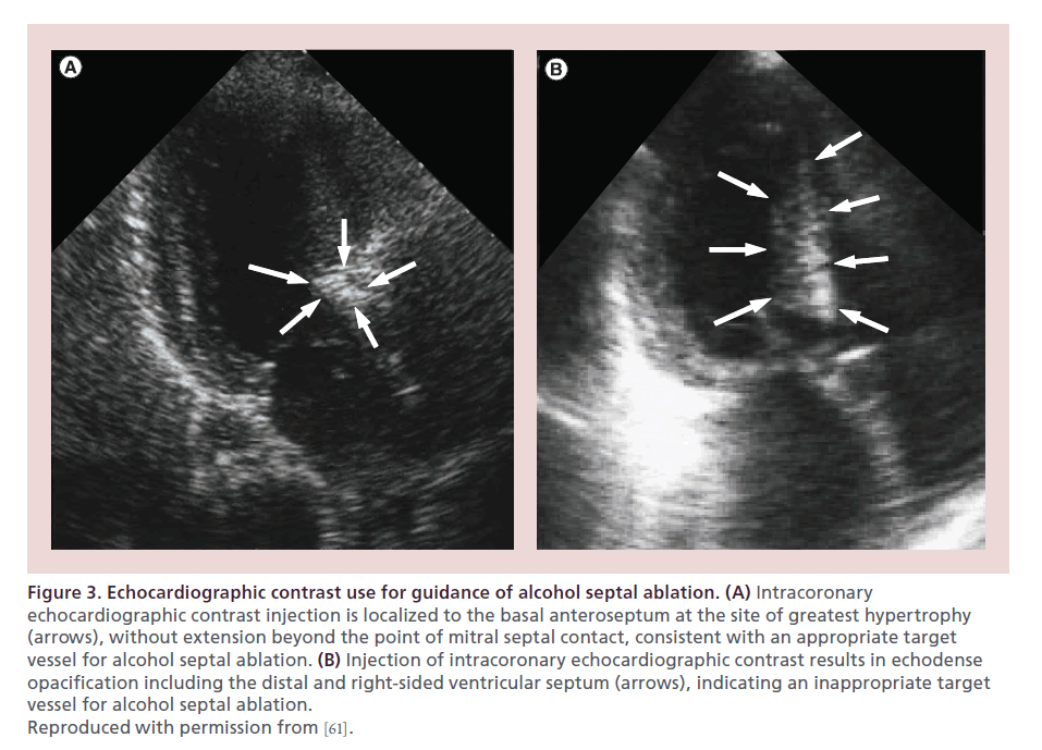 interventional-cardiology-Echocardiographic-contrast