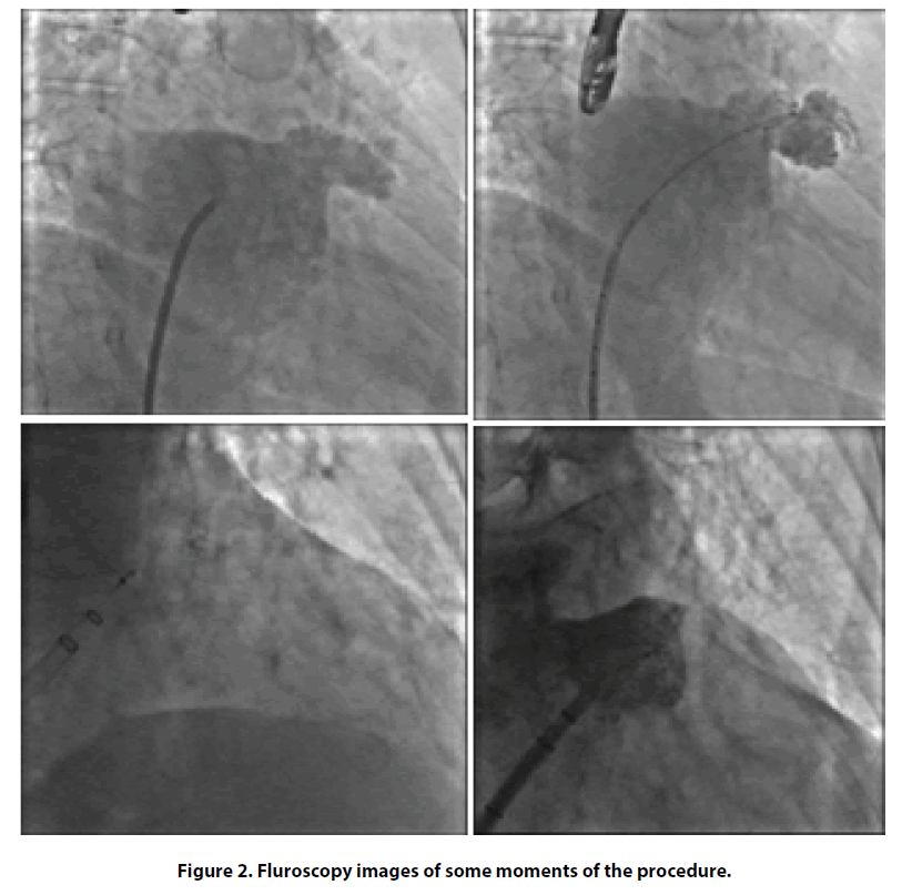 interventional-cardiology-Fluroscopy-images