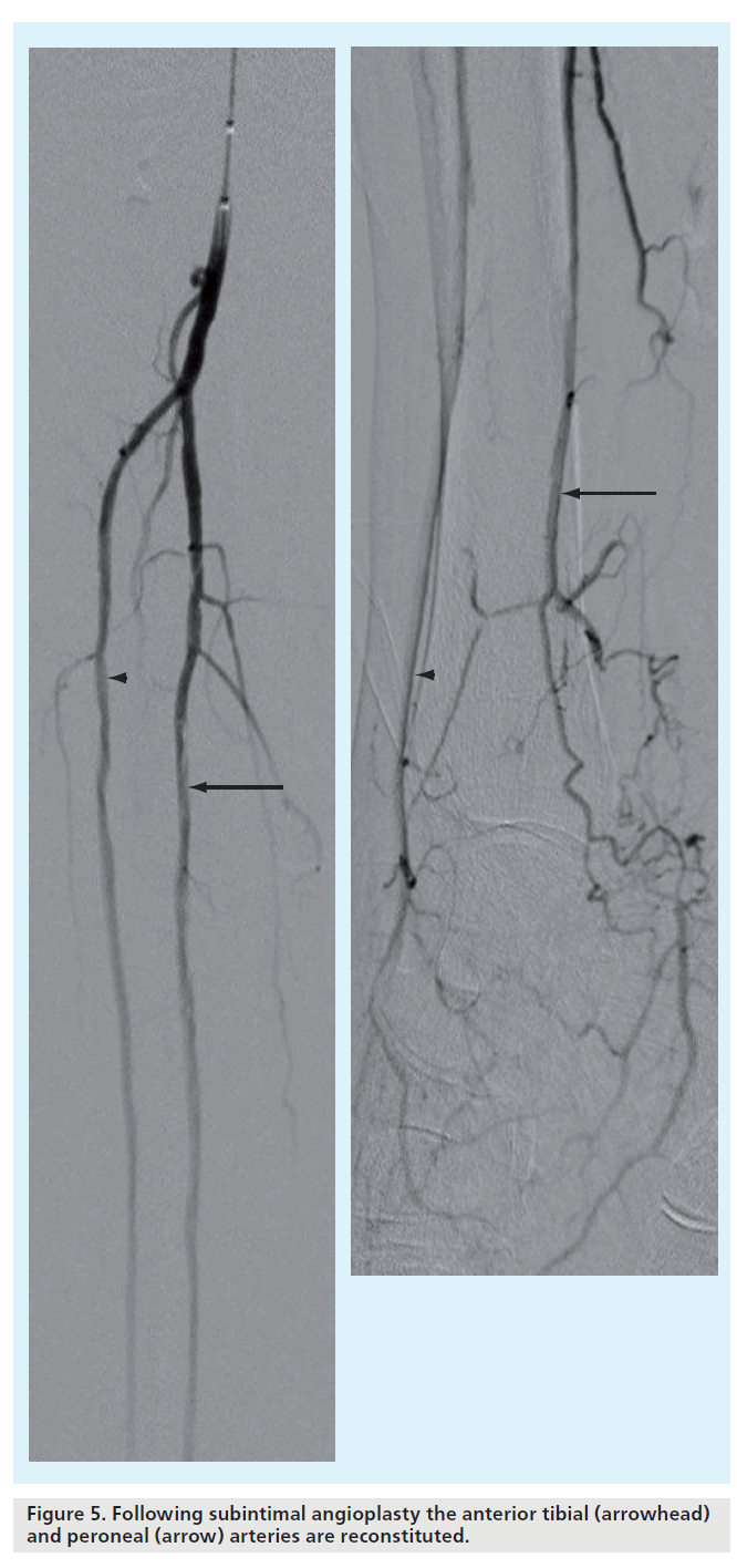 interventional-cardiology-Following-subintimal