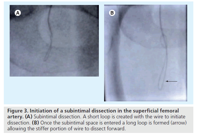 interventional-cardiology-Initiation-subintimal