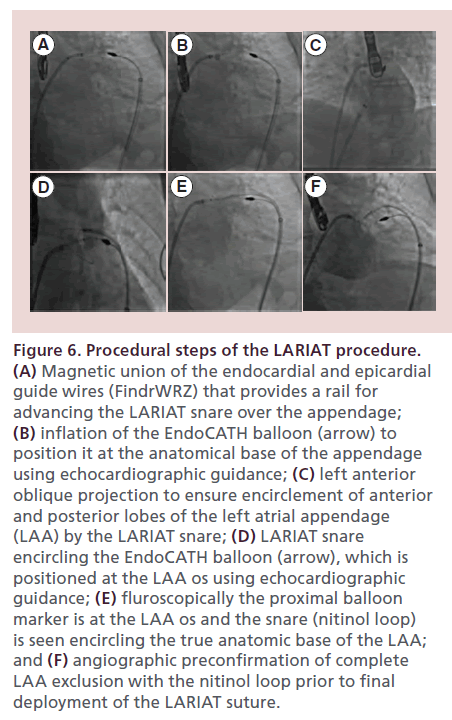 interventional-cardiology-LARIAT-procedure