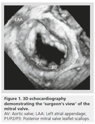 interventional-cardiology-Left-atrial-appendage