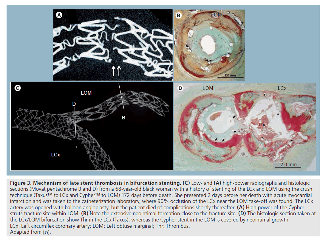 interventional-cardiology-Mechanism-late