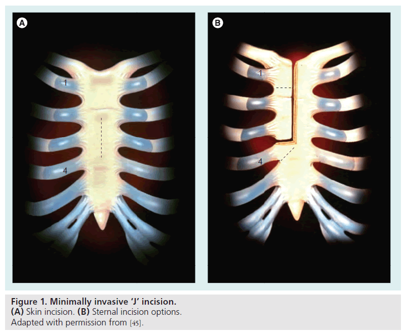 interventional-cardiology-Minimally-invasive