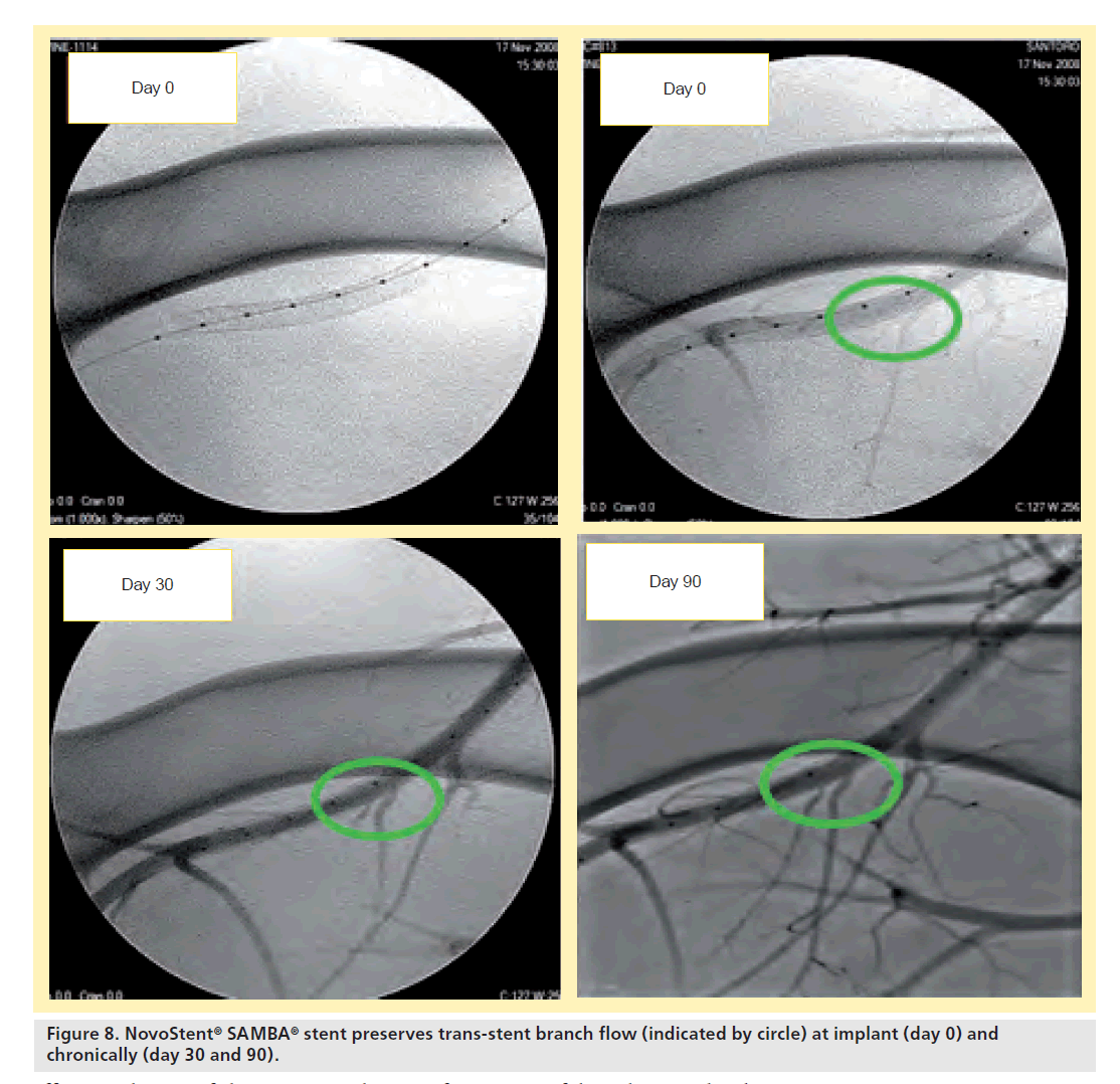 interventional-cardiology-NovoStent