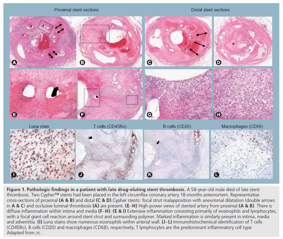 interventional-cardiology-Pathologic-findings