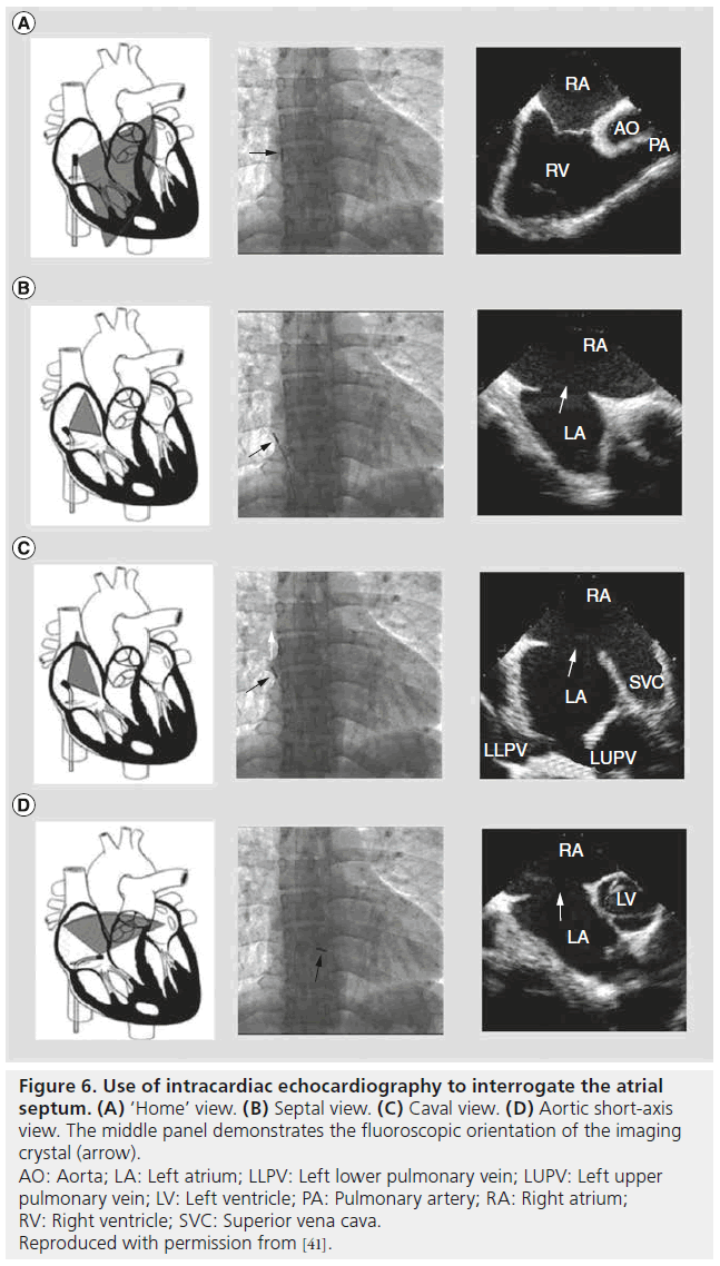 interventional-cardiology-Right-ventricle