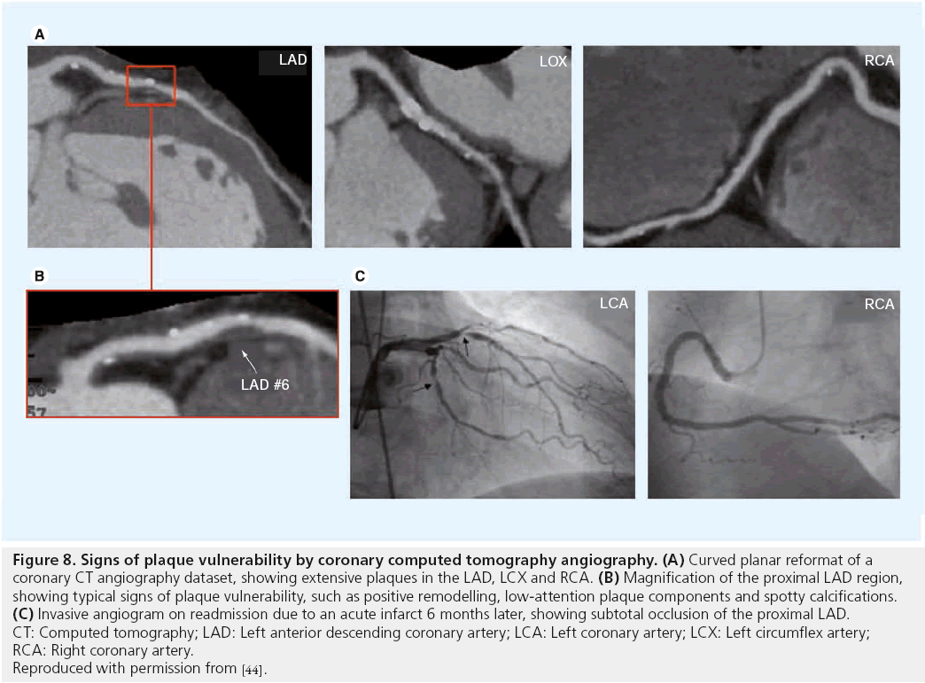 interventional-cardiology-Signs-plaque-vulnerability