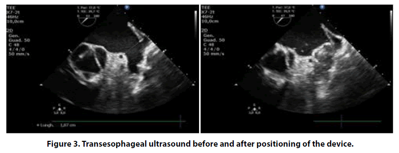 interventional-cardiology-Transesophageal