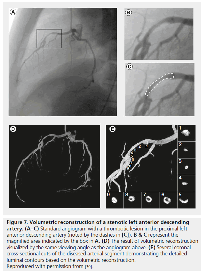 interventional-cardiology-Volumetric-lesion