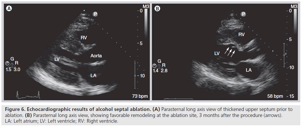 Patient selection for alcohol septal ablation for hypertrophic ob