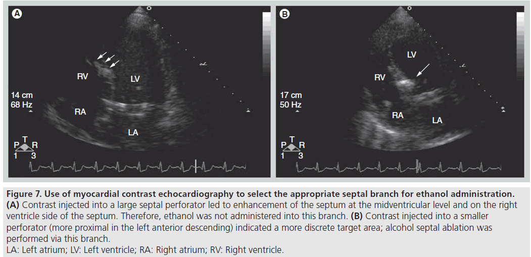 interventional-cardiology-ablation