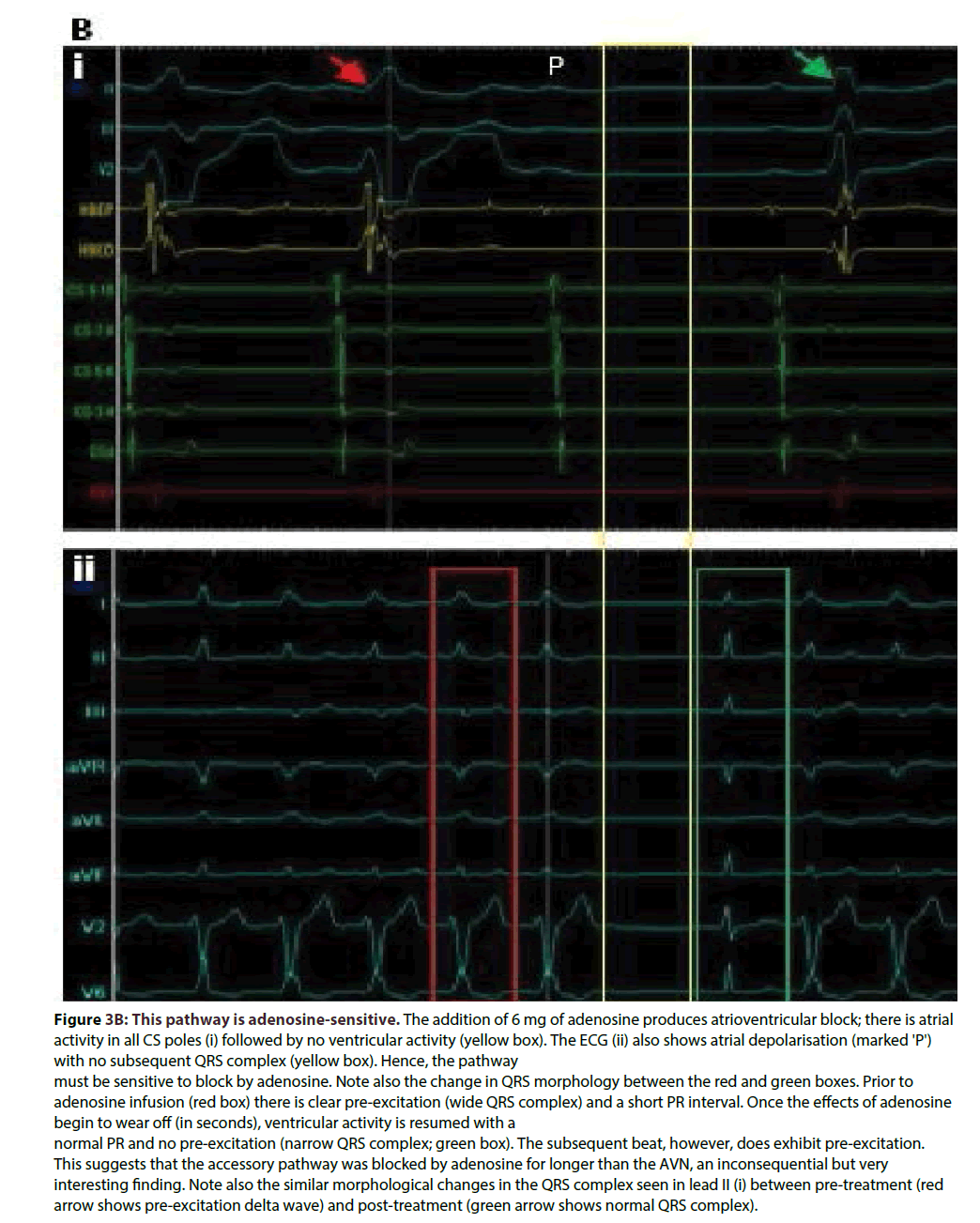 interventional-cardiology-adenosine-sensitive