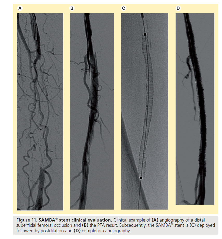 interventional-cardiology-angiography-distal