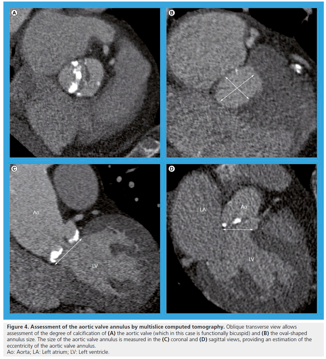 interventional-cardiology-annulus