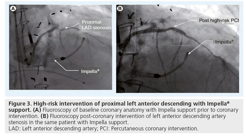 interventional-cardiology-anterior-descending