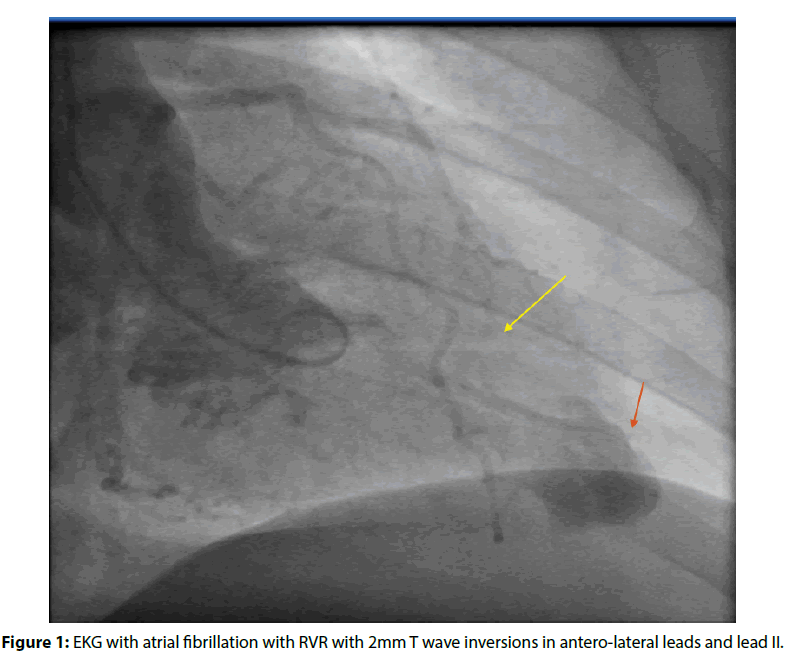 interventional-cardiology-atrial-fibrillation