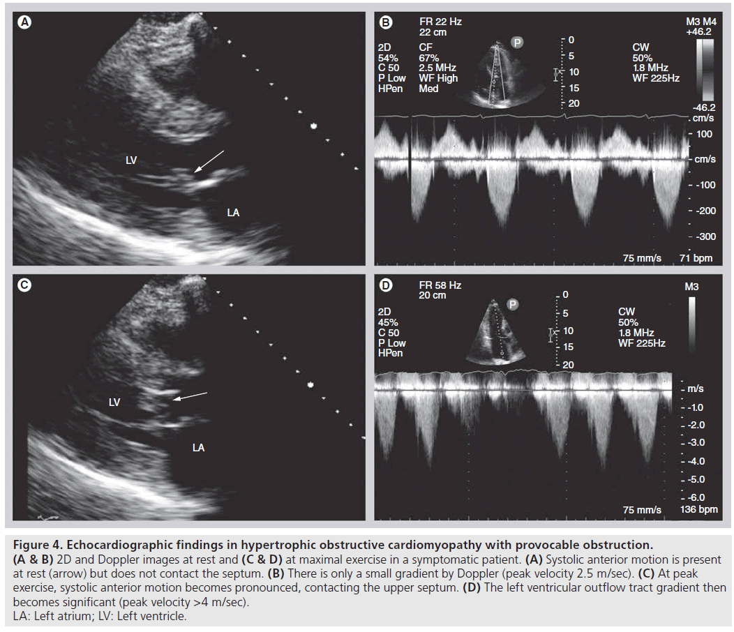 interventional-cardiology-cardiomyopathy