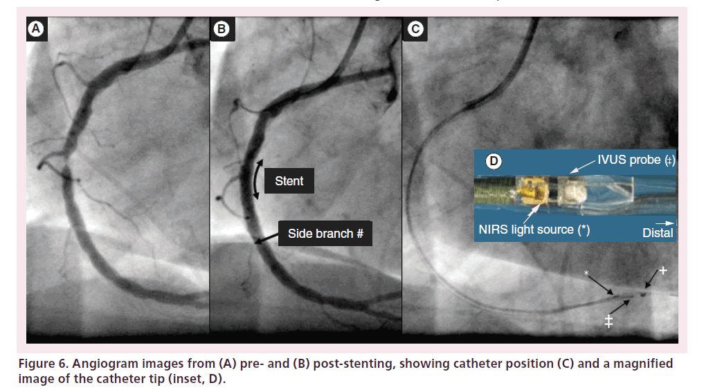interventional-cardiology-catheter-tip