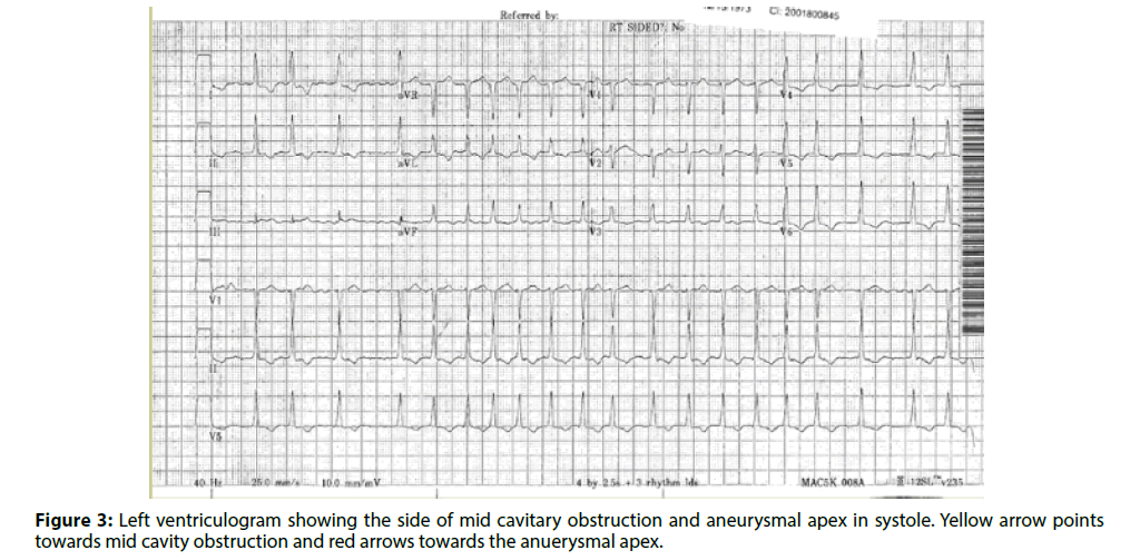 interventional-cardiology-cavitary-obstruction