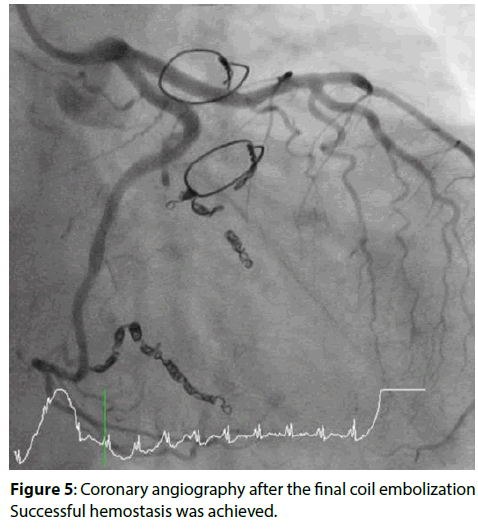 interventional-cardiology-coil-embolization