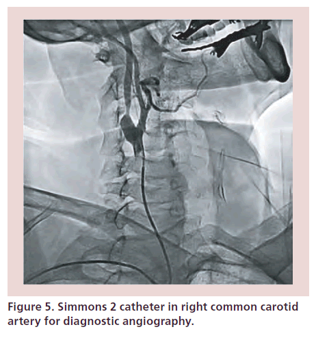 interventional-cardiology-common-carotid