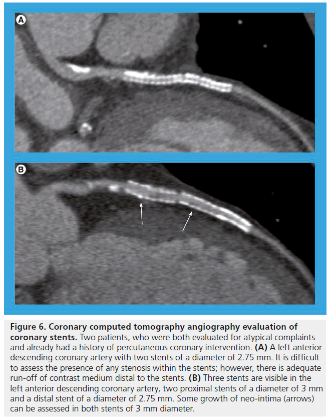 interventional-cardiology-computed