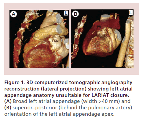 interventional-cardiology-computerized-tomographic