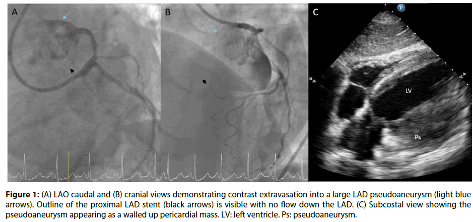 interventional-cardiology-contrast-extravasation