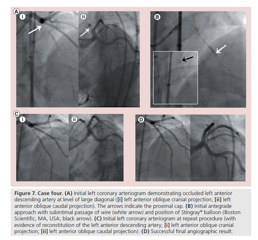 interventional-cardiology-coronary-arteriogram