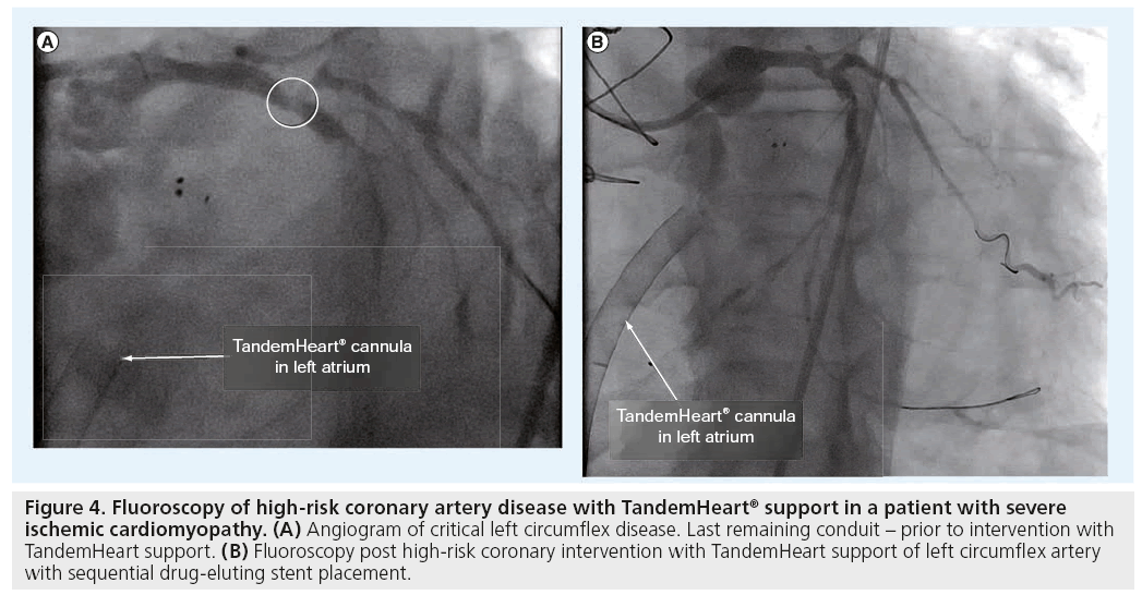 interventional-cardiology-coronary-artery