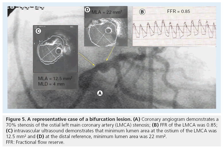 interventional-cardiology-coronary-artery