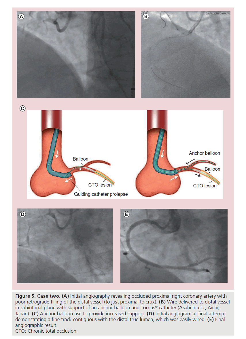 interventional-cardiology-coronary-artery