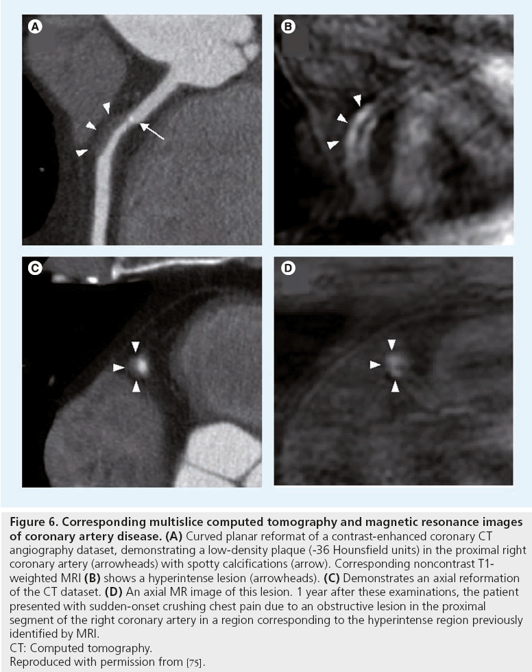 interventional-cardiology-coronary-artery-disease