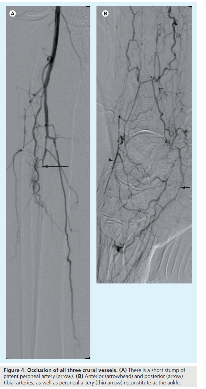 interventional-cardiology-crural-vessels