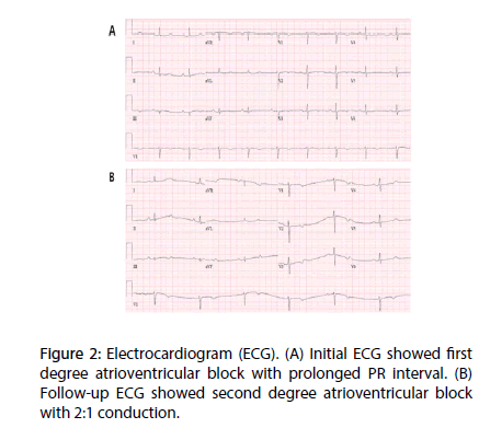 interventional-cardiology-degree-atrioventricular