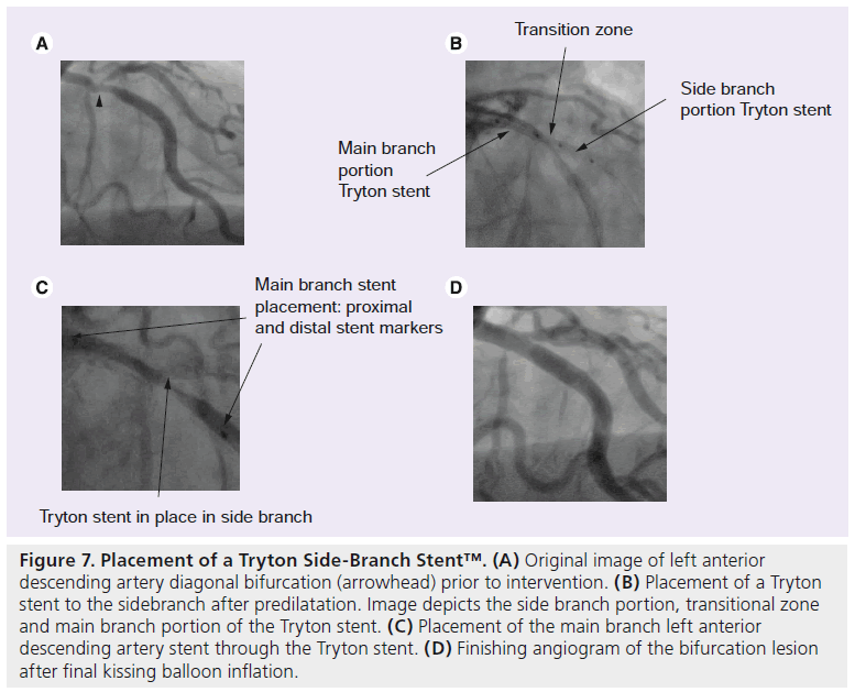 interventional-cardiology-diagonal-bifurcation