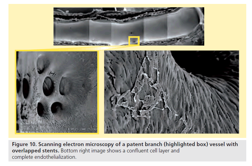 interventional-cardiology-endothelialization