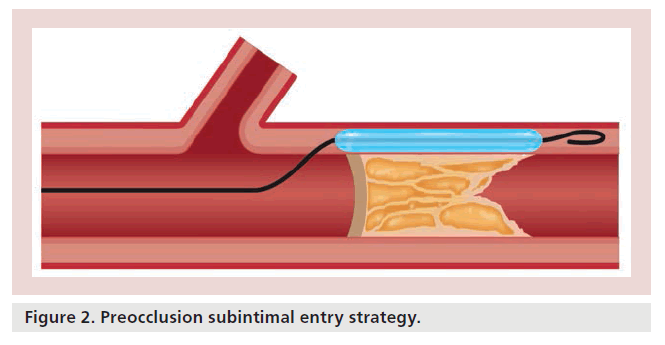 interventional-cardiology-entry-strategy