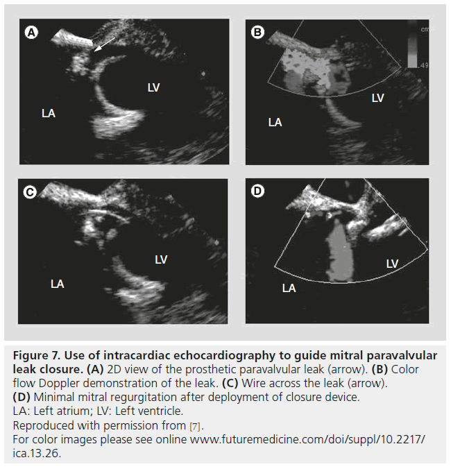 interventional-cardiology-flow-Doppler