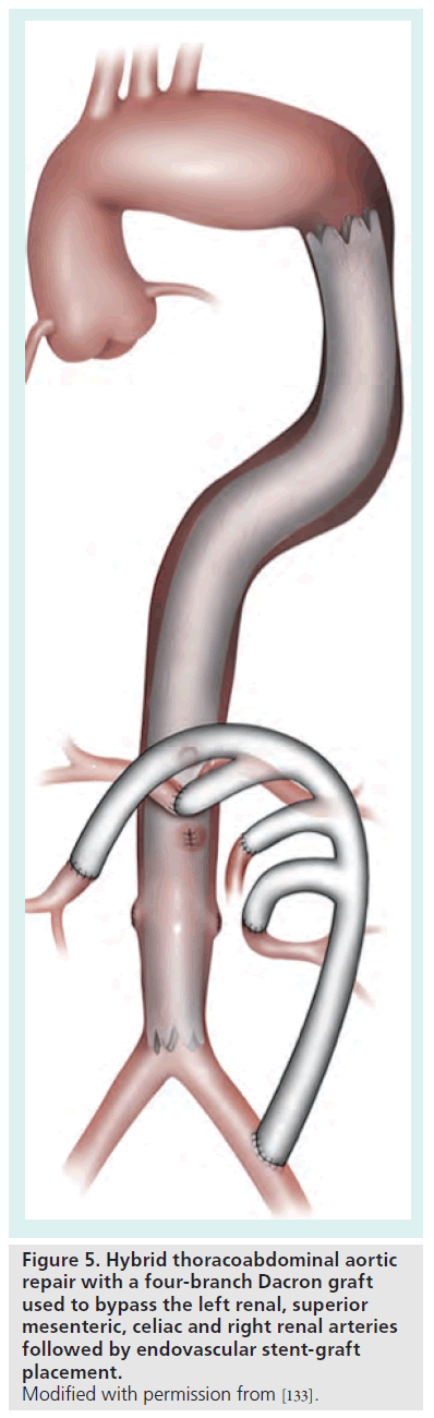 interventional-cardiology-four-branch-Dacron