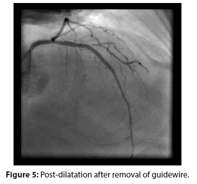 interventional-cardiology-guidewire